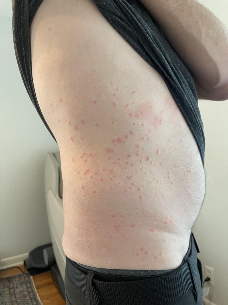 Mites biting humans?